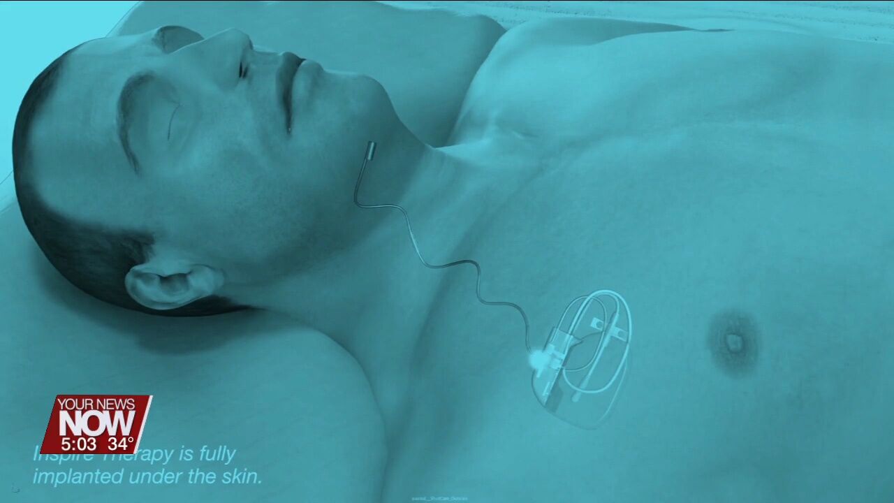 New treatment option available locally for those suffering from sleep apnea